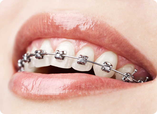 Gros plan sur des bagues dentaires posées sur les dents
