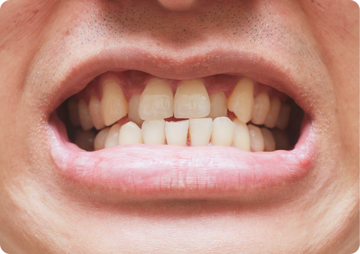 Bouche ouverte laissant apparaître des dents naturelles