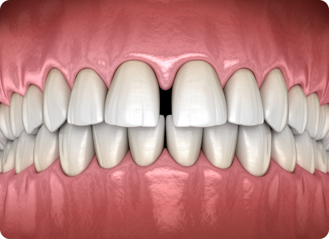 Modèle 3D de dents présentant un espace entre les incisives