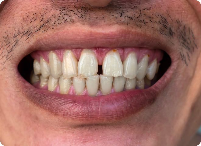 Bouche d'un homme moustachu présentant un espace entre les dents