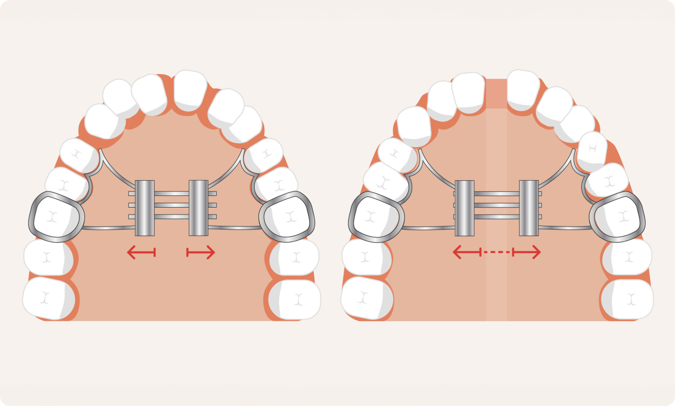 Dents du haut et du bas présentées avec des bagues orthodontiques