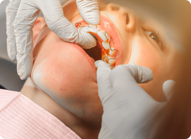 Praticien posant une gouttière transparente dans la bouche du patient