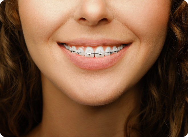 Sourire d'une femme aux dents parfaitement alignées